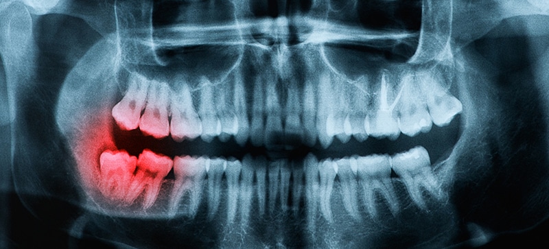 Mouth X-Ray focused on the wisdom teeth