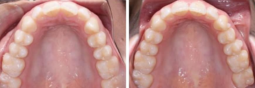 before and after Invisalign comparison fixing Openbite