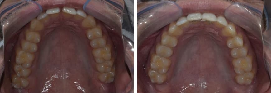 before and after Invisalign comparison fixing Diastema, Narrow Arch & Openbite