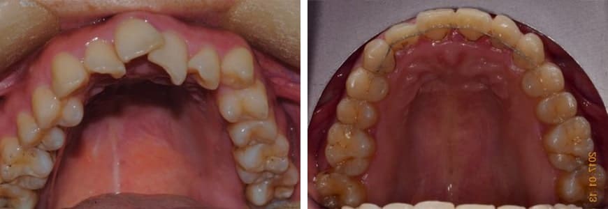 Anterior Crossbite fix with Invisalign