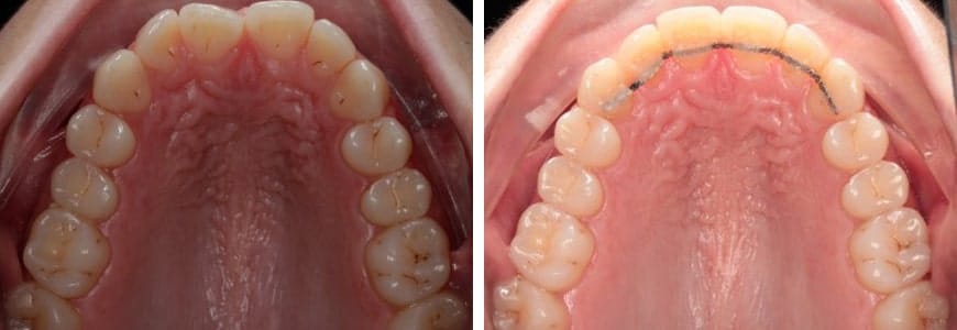 before and after Invisalign comparison fixing Diastema, Narrow Arch & Openbite