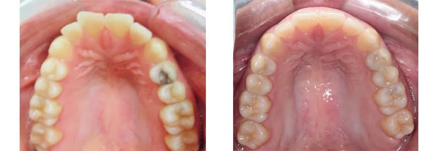 before and after Invisalign comparison fixing Openbite