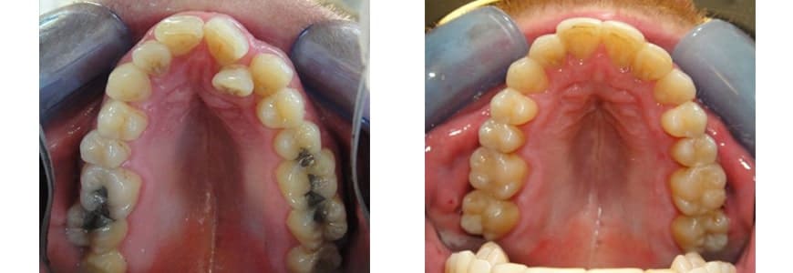 before and after Invisalign comparison fixing Anterior Crossbite