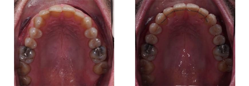 Invisalign comparison fixing Rotations in a patients mouth after 10 months