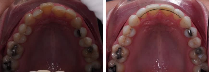 before and after Invisalign comparison fixing crowding after 10 months