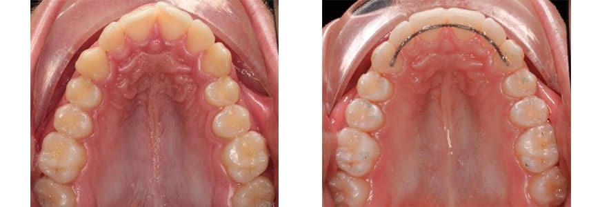 Invisalign comparison fixing Rotations in a patients mouth after 10 months