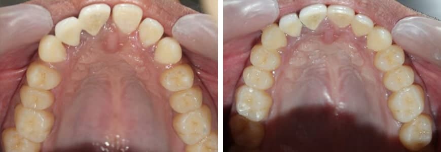 before and after Invisalign comparison fixing spacing issues between teeth