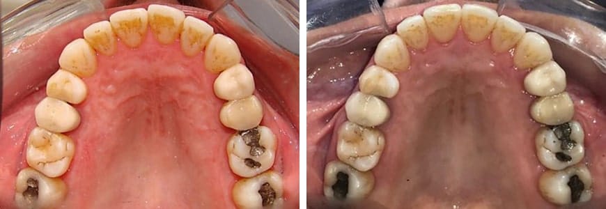 before and after Invisalign comparison fixing spacing issues between teeth