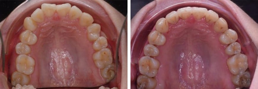 Invisalign comparison fixing Rotations in a patients mouth after 10 months