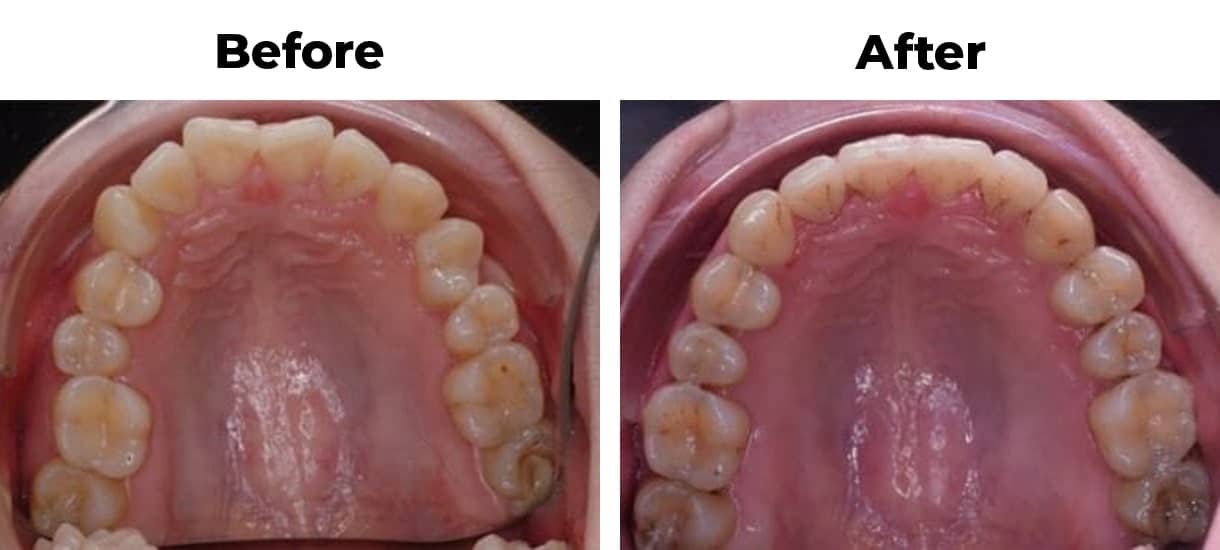 Crooked teeth whole arch invisalign before and after treatment