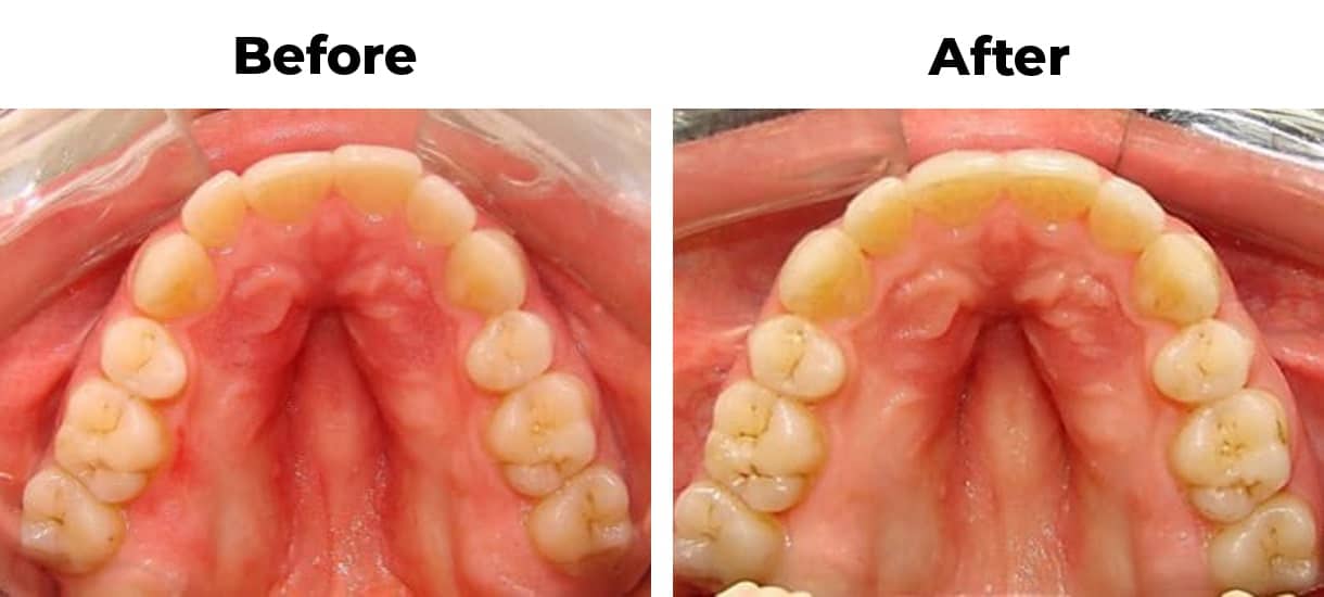 Crowded front teeth before and after invisalign treatment