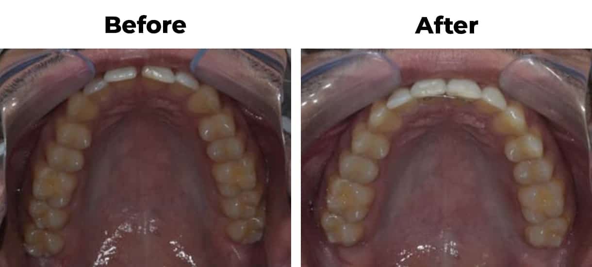 Diastema Closure invisalign before and after treatment