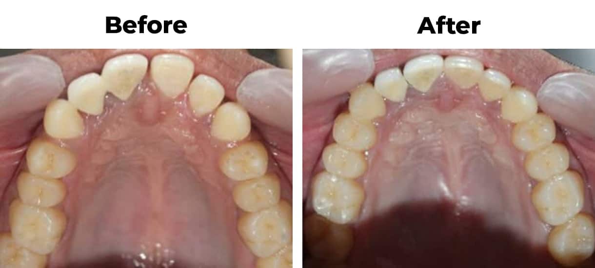 Diastema and close teeth invisalign before and after treatment