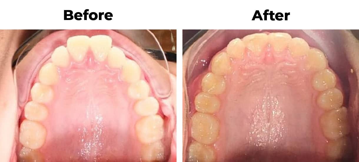 Invisalign before and after 7 months treatment