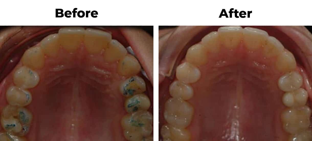 Narrow arch invisalign before and after treatment