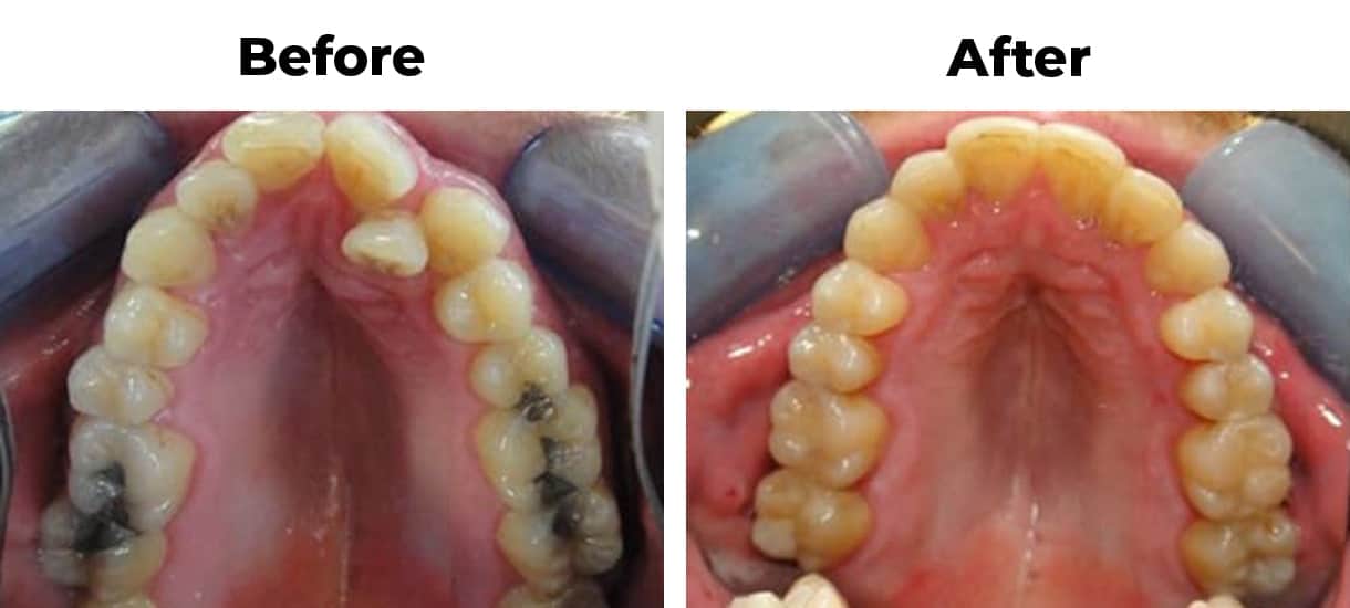 Not enough space invisalign before and after treatment