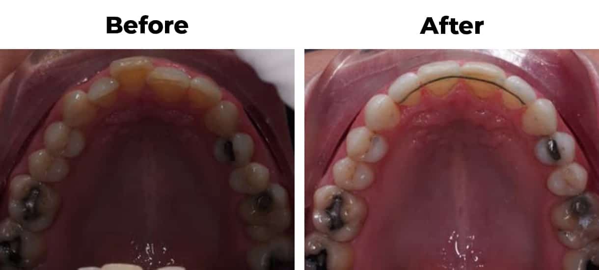 Overlapping crowding invisalign before and after treatment