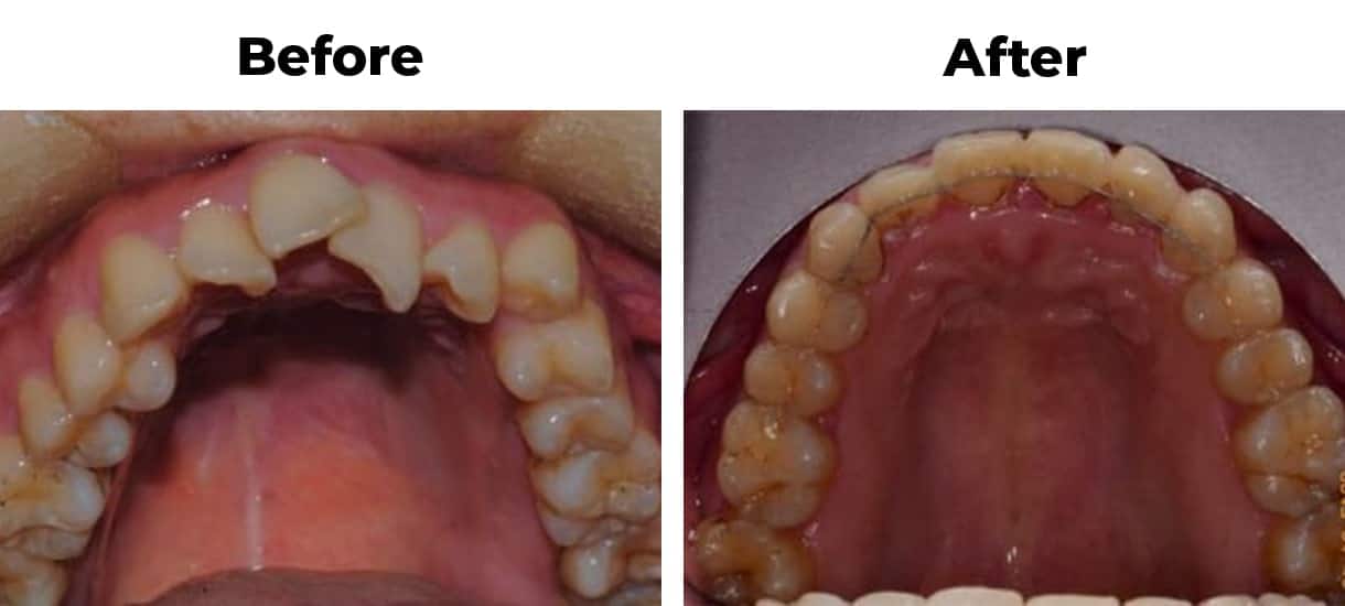 Overlapping front teeth invisalign before and after treatment