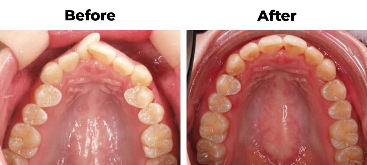 Overlapping front teeth overcrowding invisalign before and after treatment