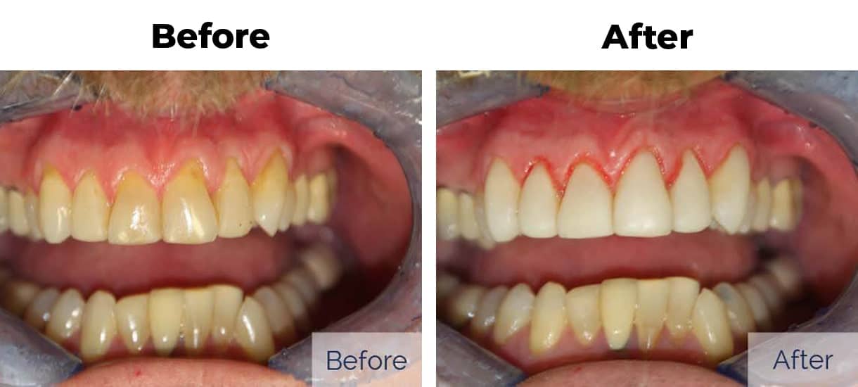 Patient before and after receding gums and discolored teeth