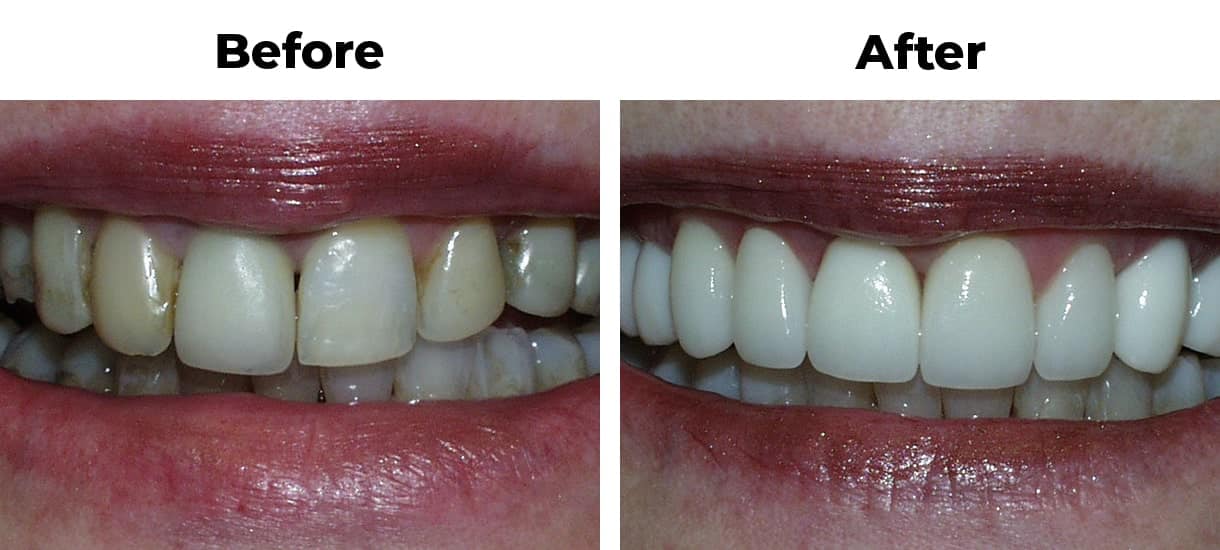 Patient before and after uneven teeth porcelain veneers