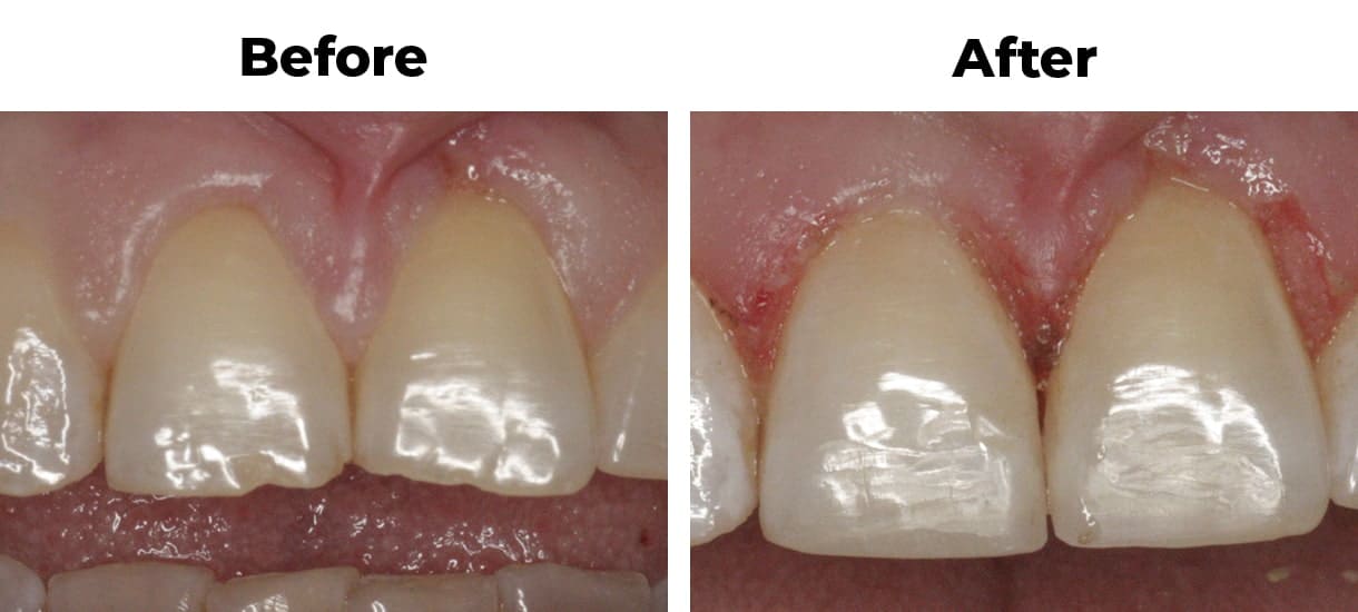 Patient before and after chipped teeth gum recontouring