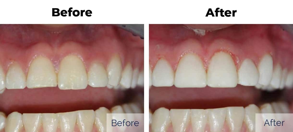 Patient before and after chipped tooth cosmetic bonding