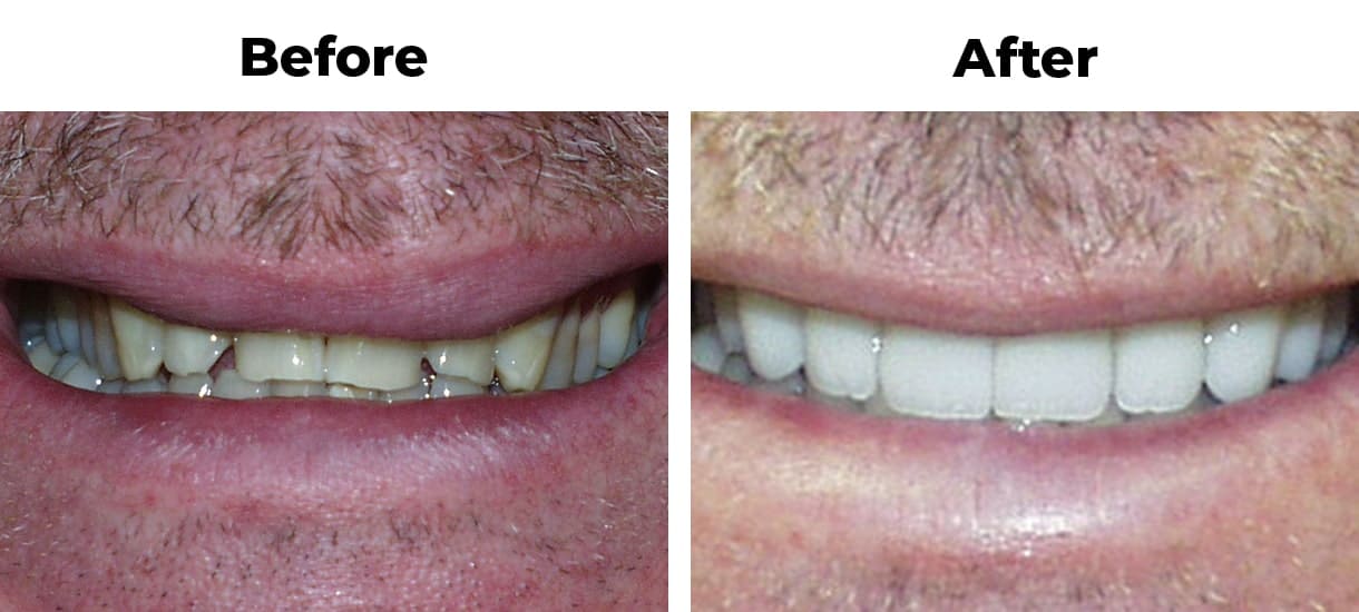 Patient before and after dark stains porcelain veneers