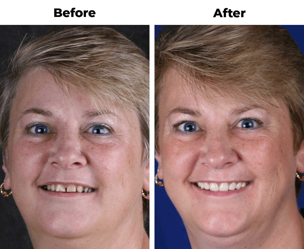 Patient before and after diastema closure porcelain veneers