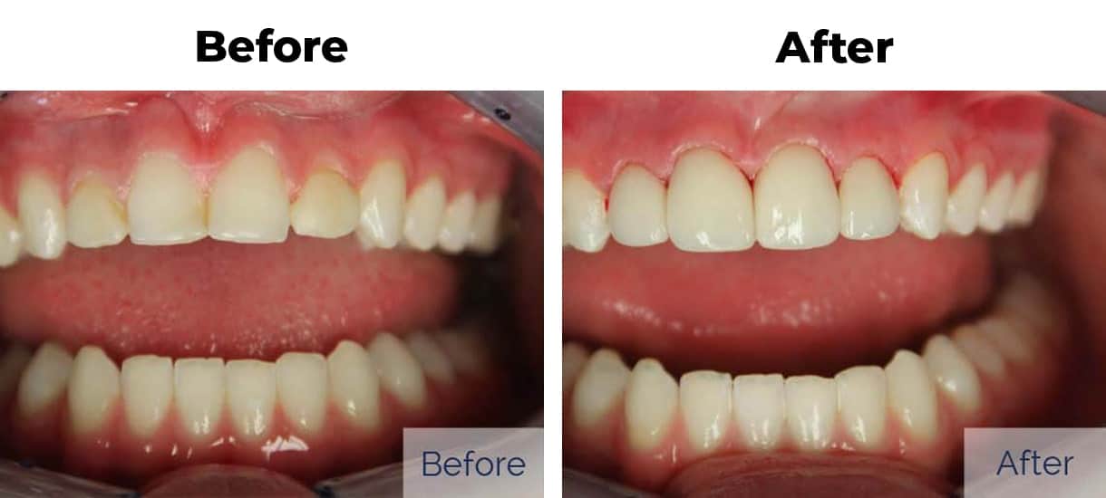 Patient before and after discolored teeth porcelain veneers four