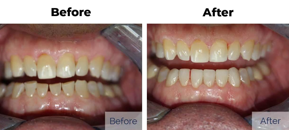 Patient before and after discolored teeth porcelain veneers