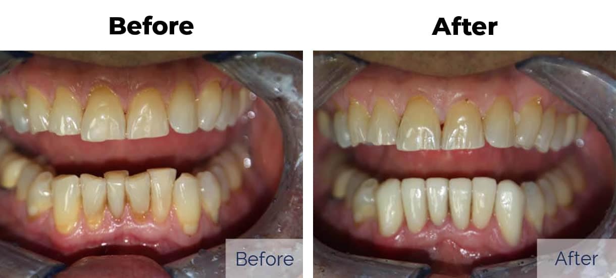 Patient before and after discolored teeth porcelain veneers one