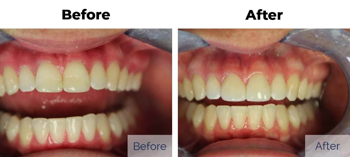 Patient before and after discolored teeth porcelain veneers three