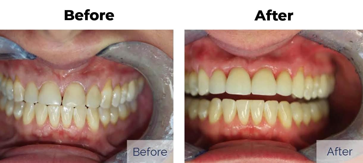 Patient before and after discolored teeth porcelain veneers two