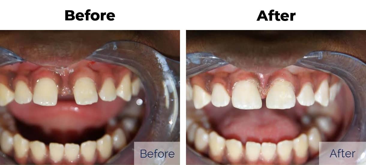 Patient before and after diastema closure cosmetic bonding