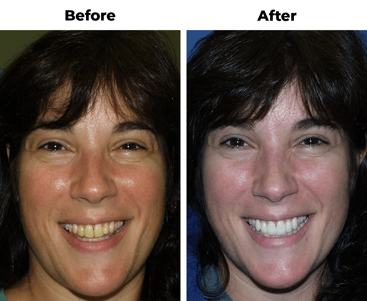 Patient before and after filling replacement porcelain veneers