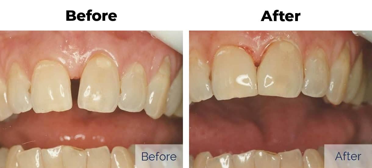 Patient before and after front teeth cosmetic bonding