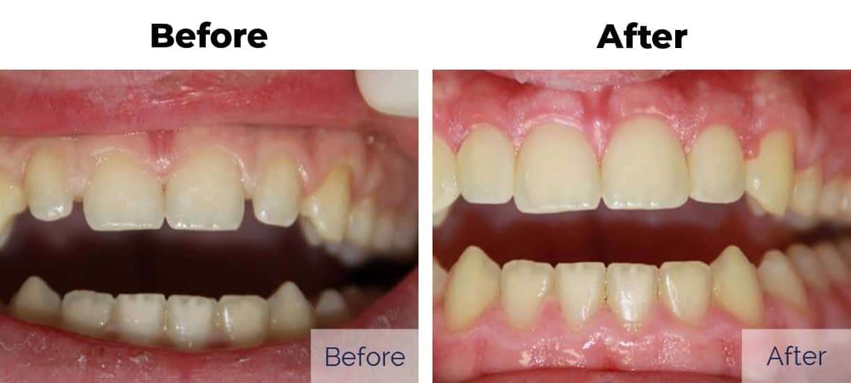 Patient before and after gapped teeth cosmetic bonding