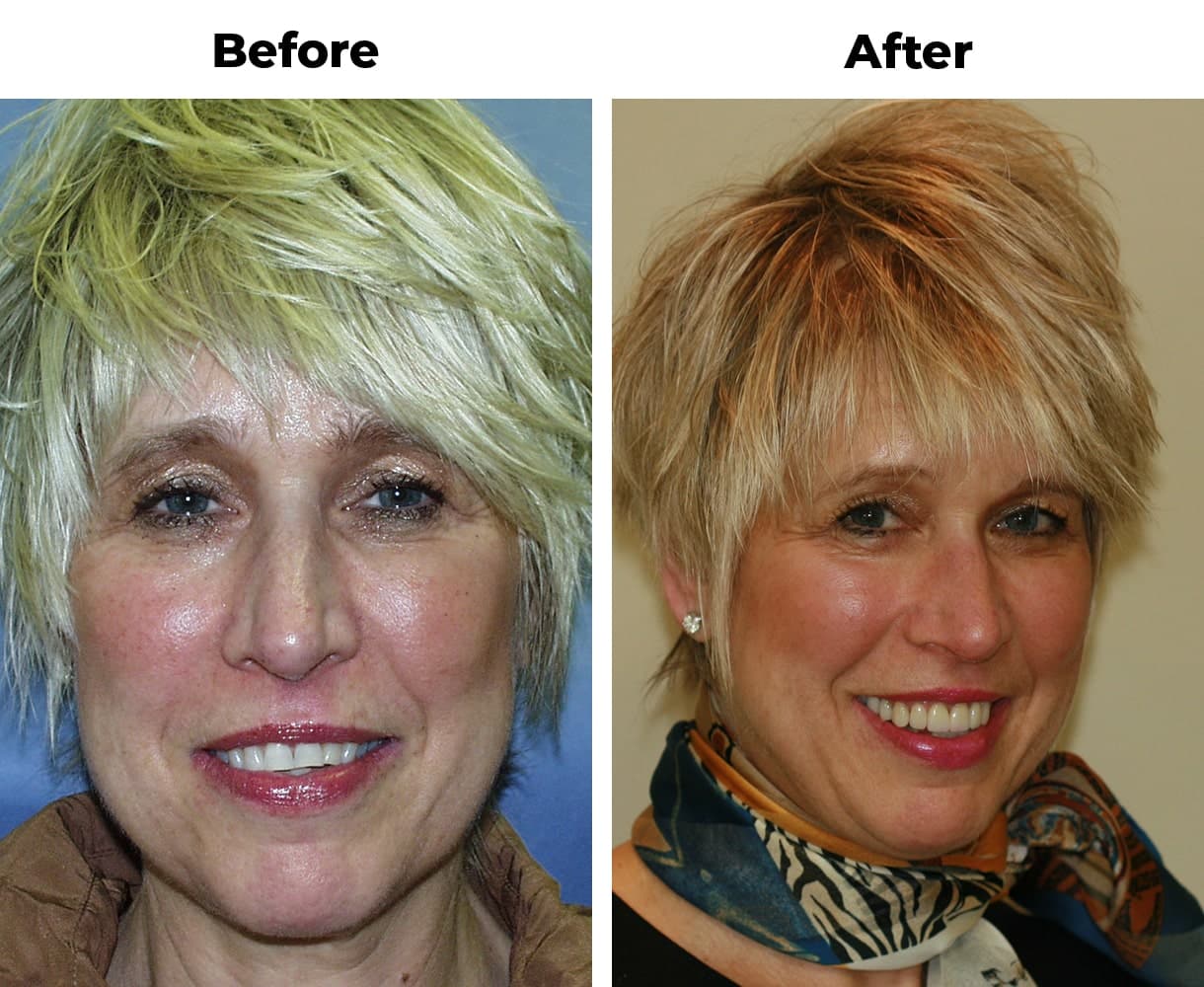 Patient before and after improving color porcelain veneers