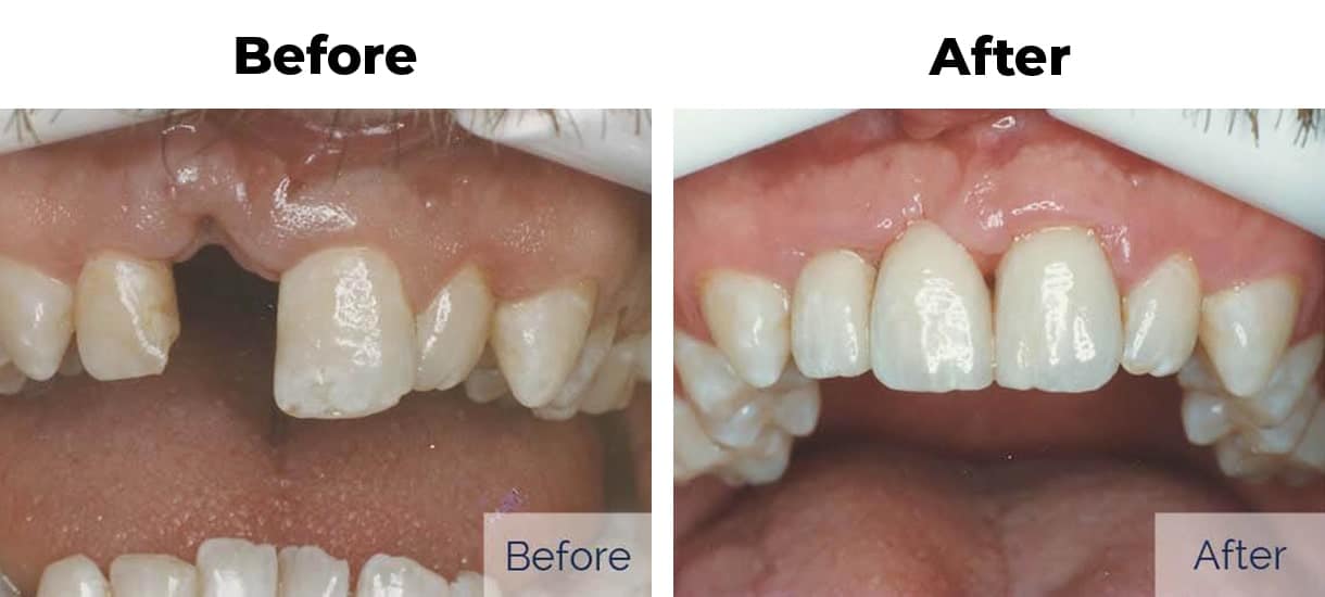 Patient before and after missing tooth bridge