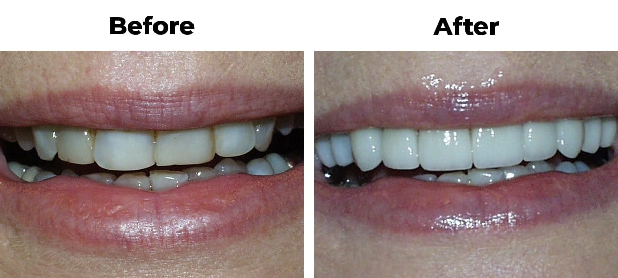 Patient before and after old fillings porcelain veneers