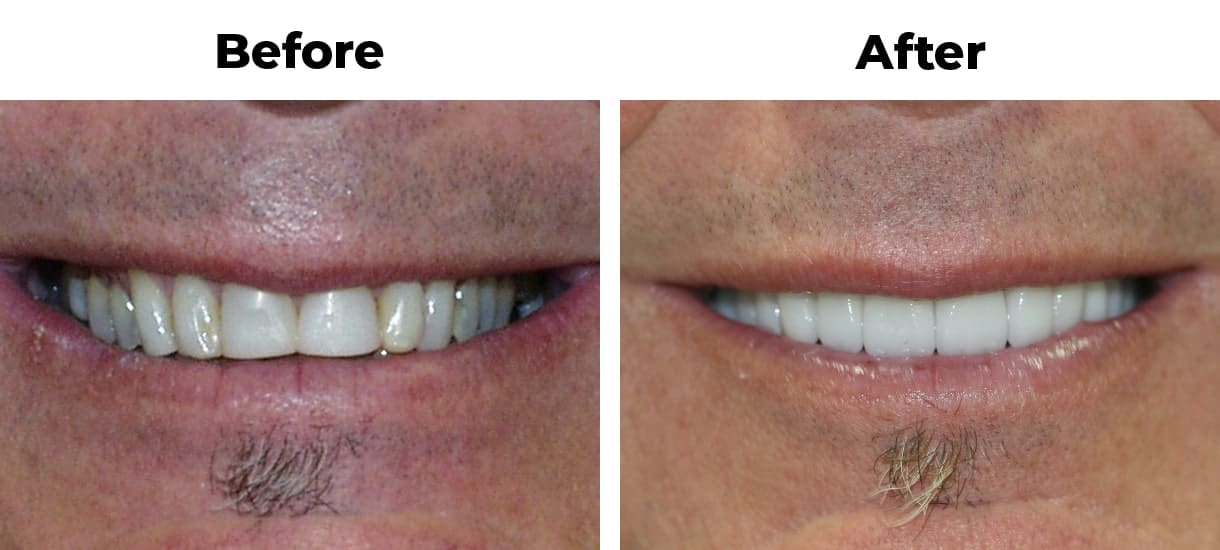 Patient before and after older restorations porcelain veneers