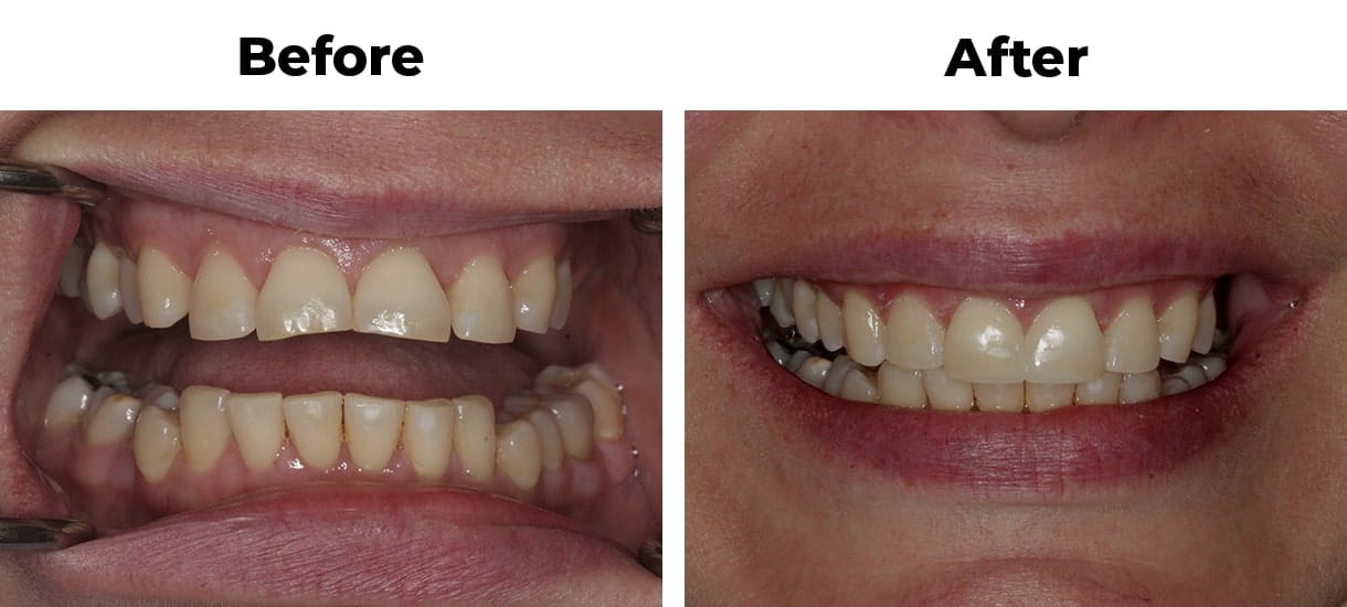 Patient before and after orthodontics and dental bonding