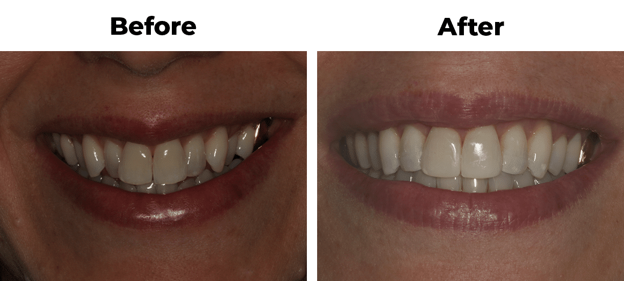 Patient before and after overcrowding orthodontics