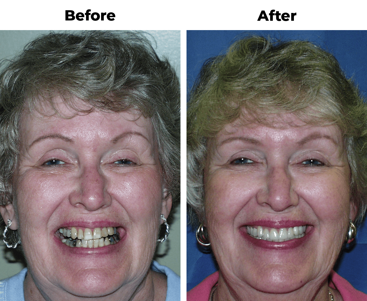 Patient before and after partial dentures and porcelain veneers