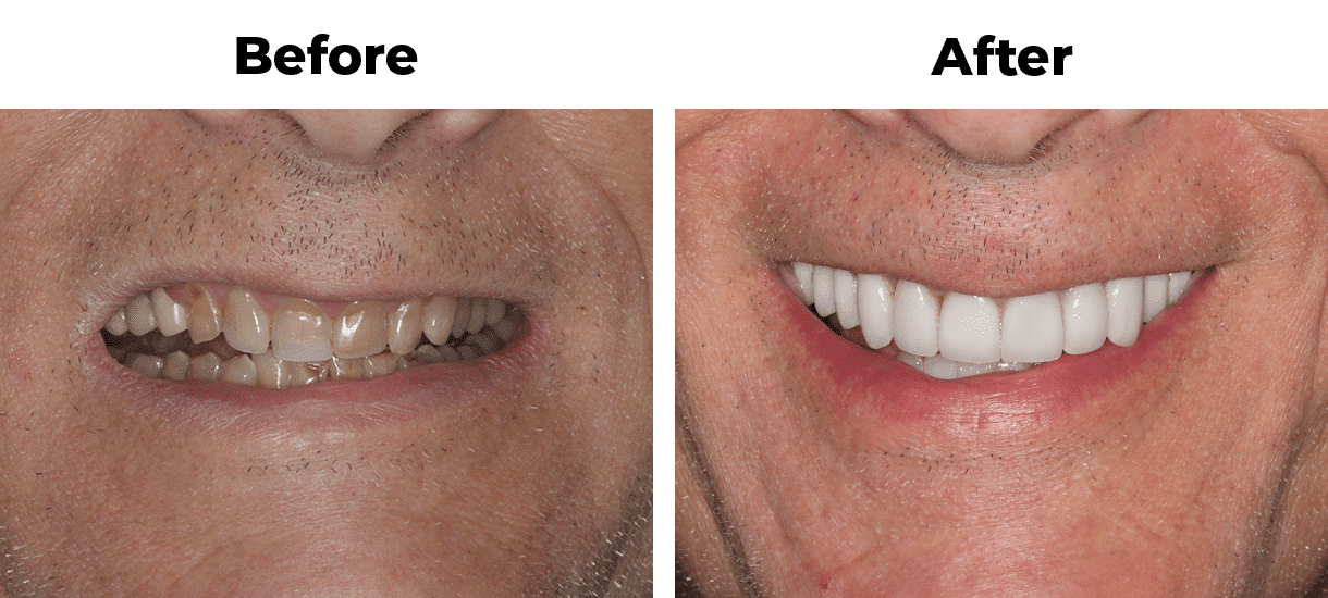 Patient before and after porcelain veneers and crowns