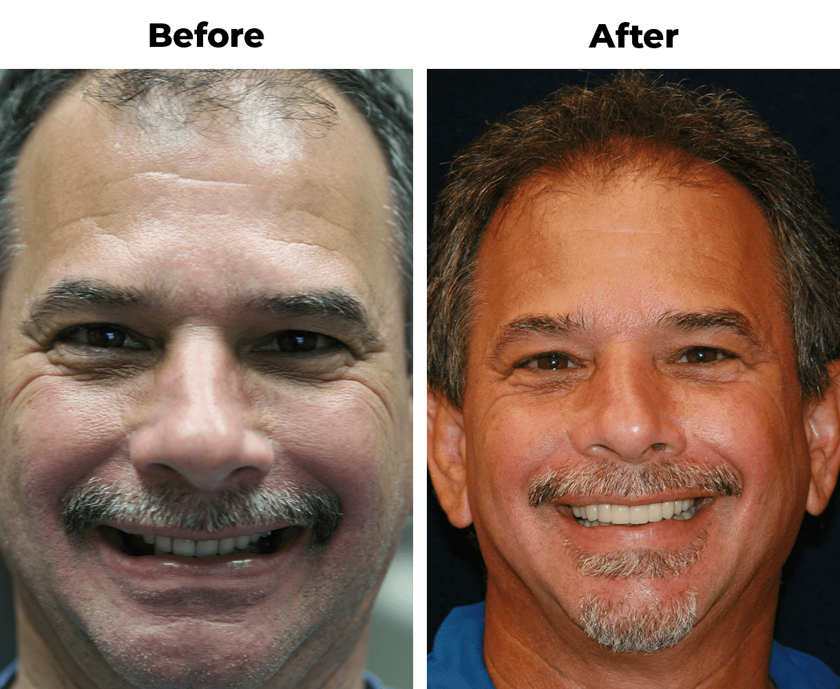 Patient before and after porcelain veneers for worn teeth