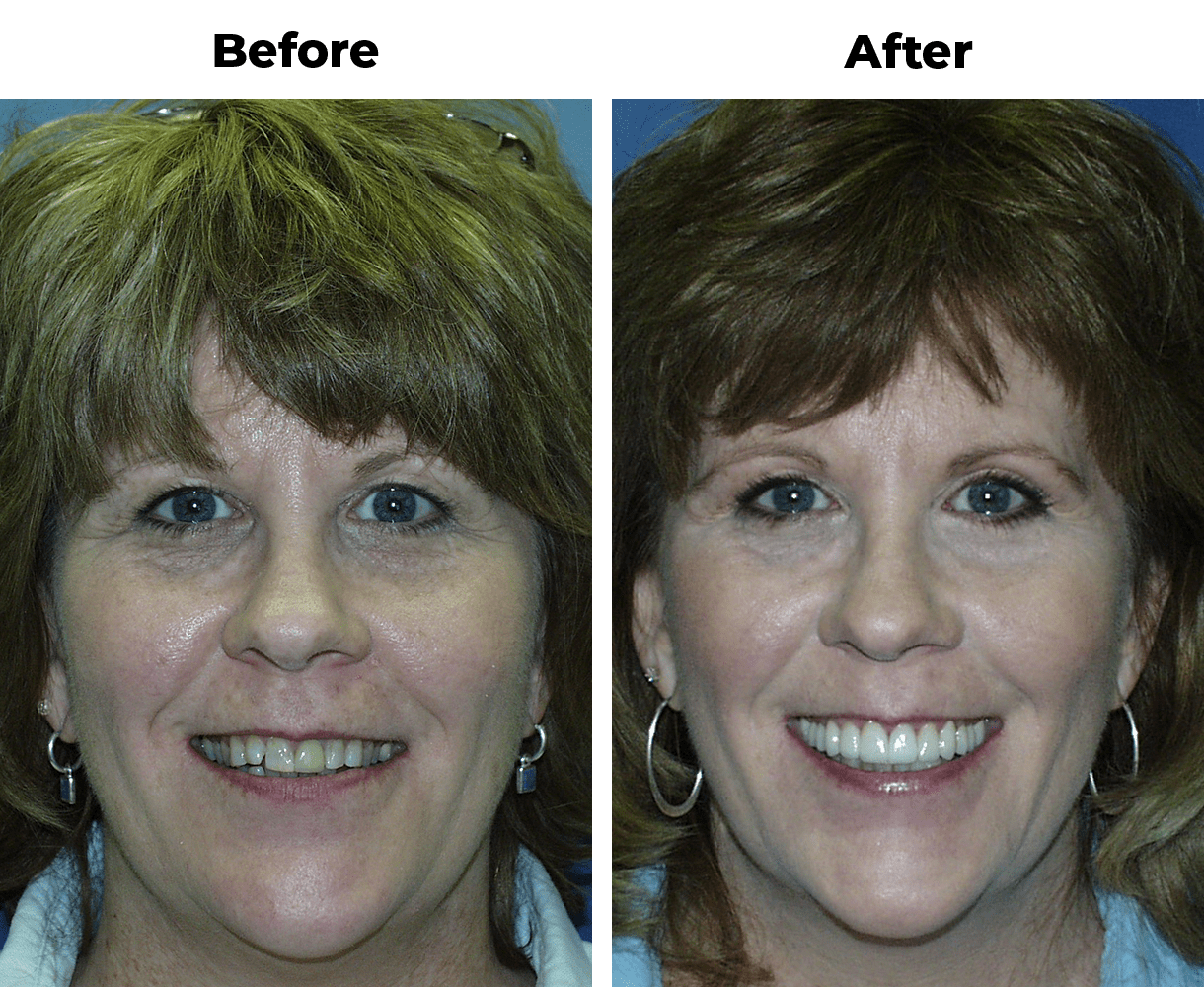 Patient before and after porcelain veneers to fix chipped teeth