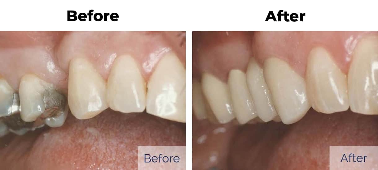 Patient before and after replacing missing tooth