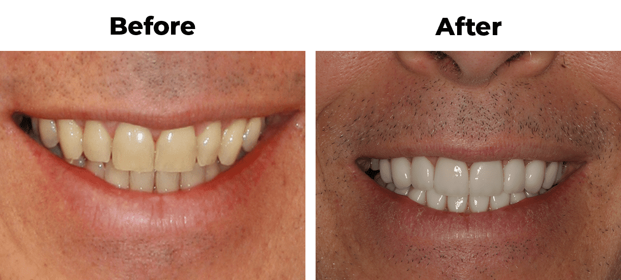 Patient before and after reshape teeth porcelain veneers